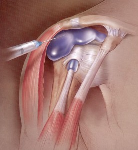 Steroid injection shoulder infection