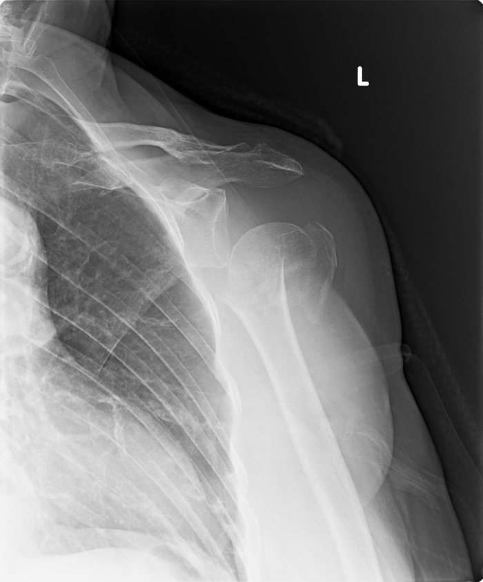 Humerus-fracture-before