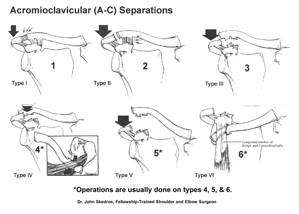 Dr. John Skedros Shoulder Procedures