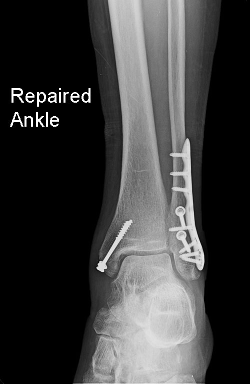 Ankle-fracture-fixation