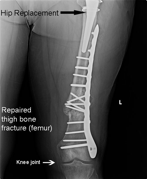 Broken-femur-below-hip-replacement