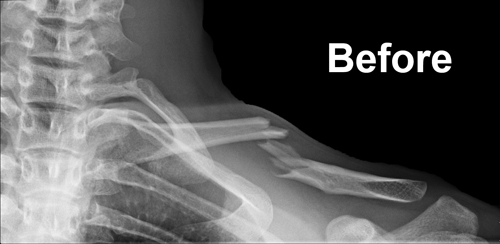 Clavicle-Fracture-Before