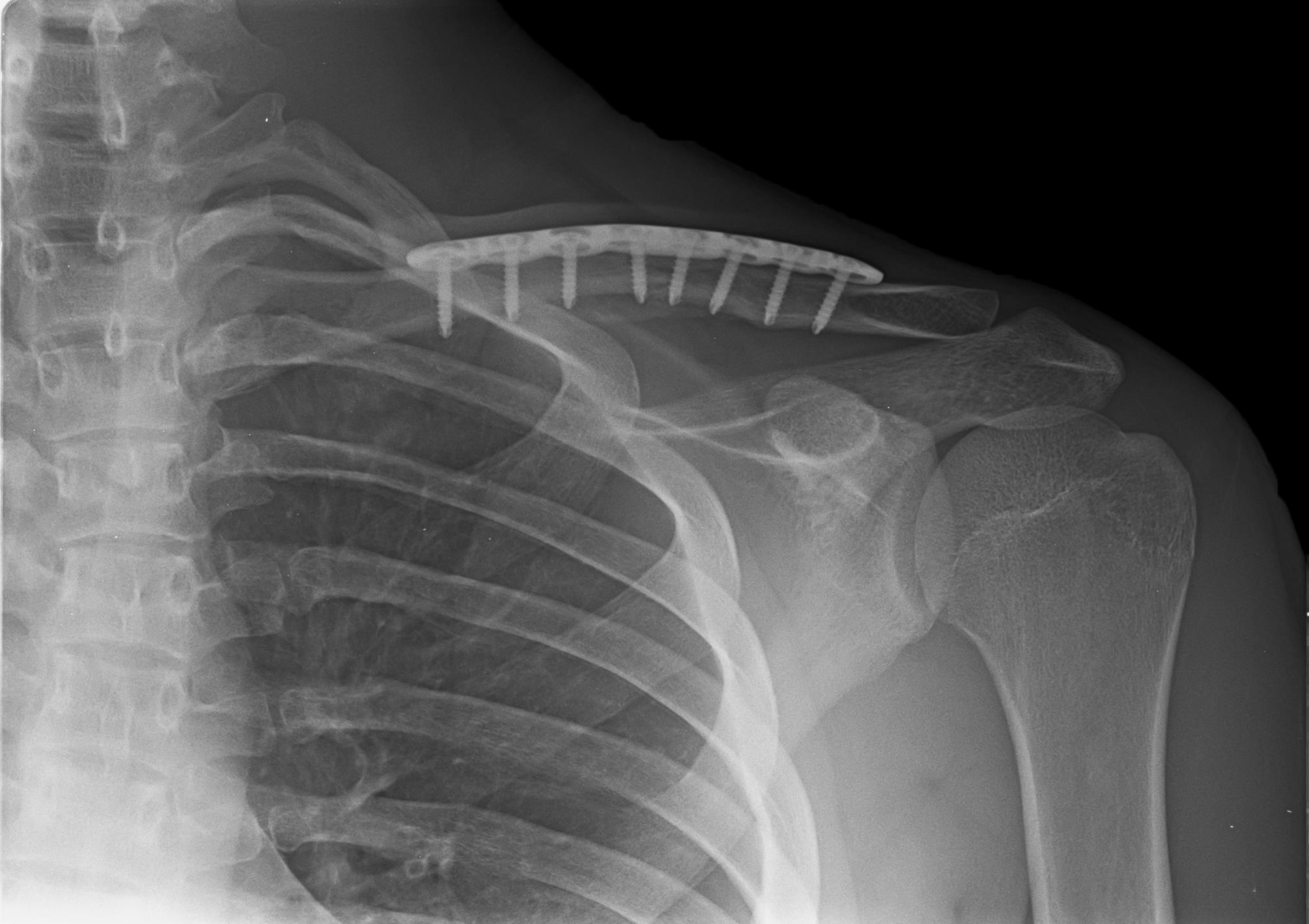 Clavicle-fracture after