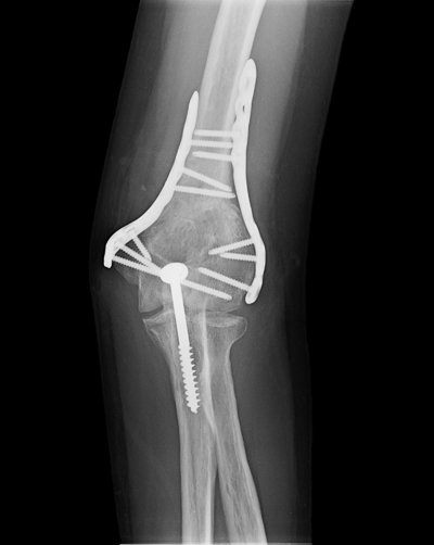 dr skedros Salt Lake elbow fracture Elbow fracture side