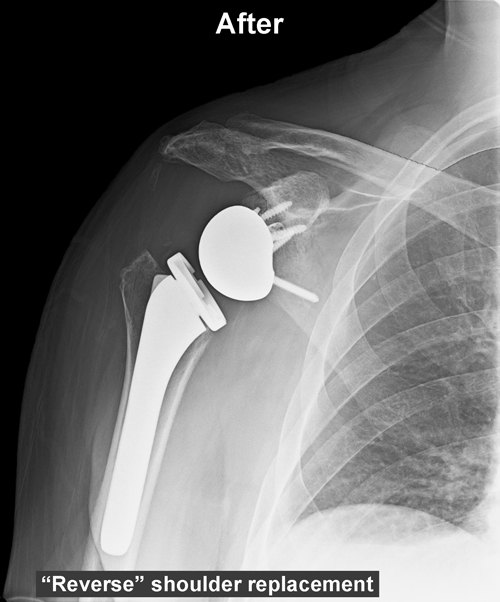Reversed shoulder replacement