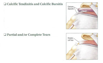 diagram of  Calcific tendinitis and tears in shoulder 