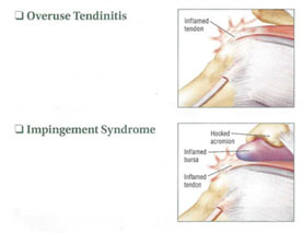 diagram of shoulder tendinitis and impingement