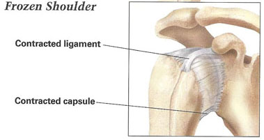 diagram of frozen shoulder