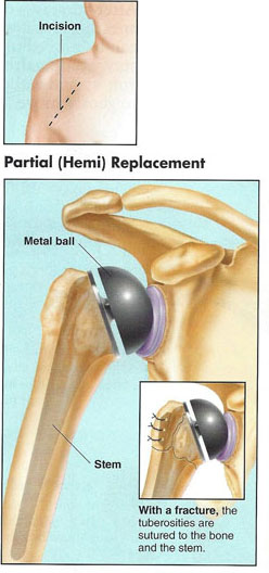diagram of partial shoulder replacement