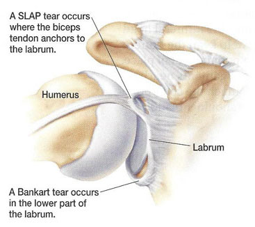 diagram of unstable shoulder