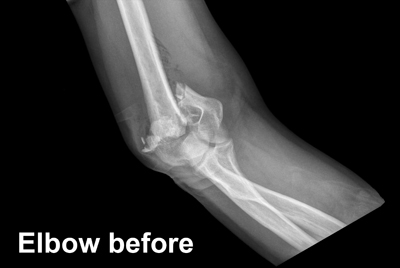Elbow fracture side